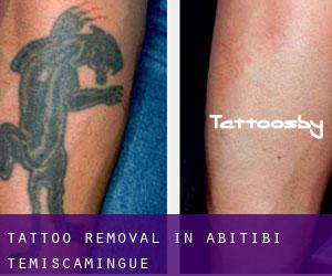 Tattoo Removal in Abitibi-Témiscamingue
