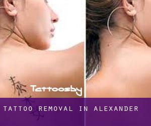 Tattoo Removal in Alexander