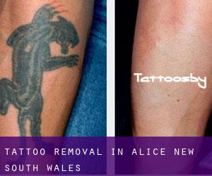 Tattoo Removal in Alice (New South Wales)