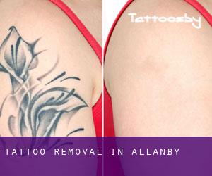 Tattoo Removal in Allanby