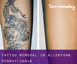 Tattoo Removal in Allentown (Pennsylvania)