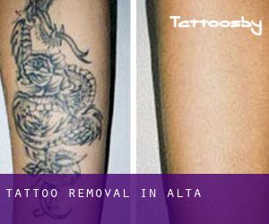 Tattoo Removal in Alta