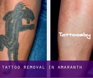 Tattoo Removal in Amaranth