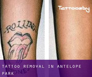 Tattoo Removal in Antelope Park