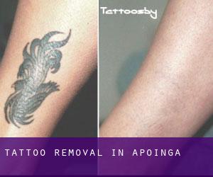 Tattoo Removal in Apoinga