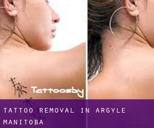 Tattoo Removal in Argyle (Manitoba)