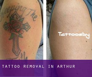 Tattoo Removal in Arthur