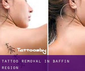 Tattoo Removal in Baffin Region