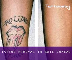 Tattoo Removal in Baie-Comeau