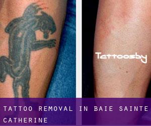 Tattoo Removal in Baie-Sainte-Catherine