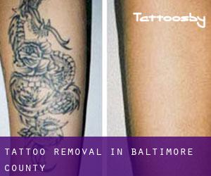 Tattoo Removal in Baltimore County