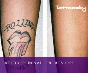 Tattoo Removal in Beaupré