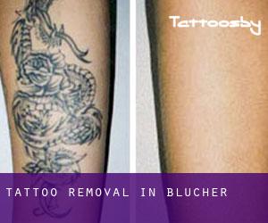 Tattoo Removal in Blucher