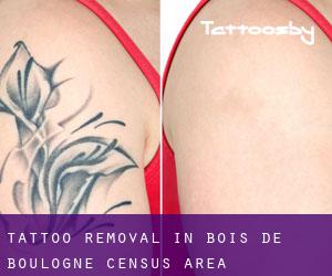 Tattoo Removal in Bois-de-Boulogne (census area)