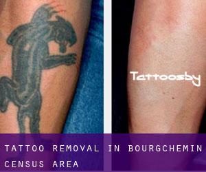 Tattoo Removal in Bourgchemin (census area)