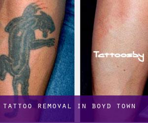 Tattoo Removal in Boyd Town