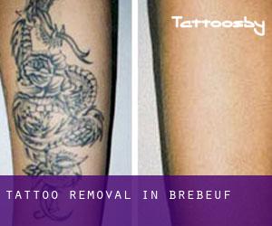 Tattoo Removal in Brébeuf