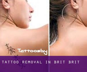 Tattoo Removal in Brit Brit