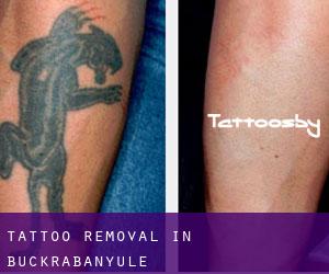 Tattoo Removal in Buckrabanyule