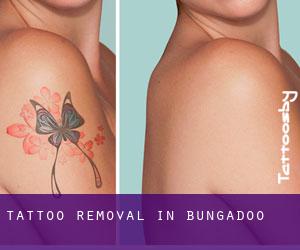 Tattoo Removal in Bungadoo