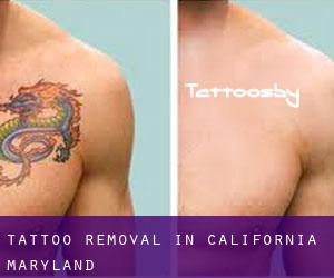 Tattoo Removal in California (Maryland)