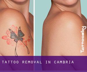 Tattoo Removal in Cambria