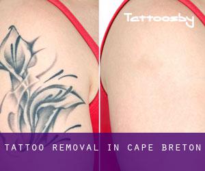 Tattoo Removal in Cape Breton