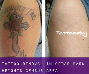 Tattoo Removal in Cedar Park Heights (census area)