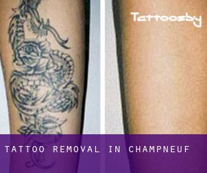 Tattoo Removal in Champneuf
