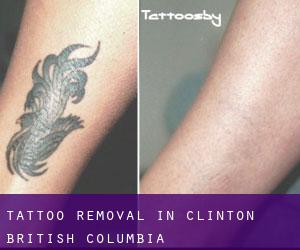 Tattoo Removal in Clinton (British Columbia)