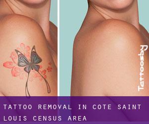 Tattoo Removal in Côte-Saint-Louis (census area)