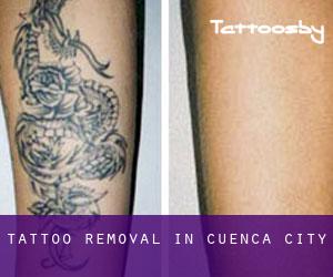 Tattoo Removal in Cuenca (City)