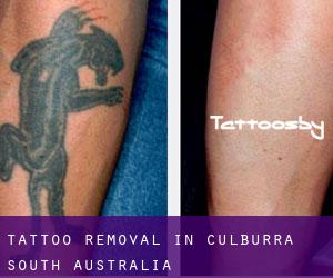 Tattoo Removal in Culburra (South Australia)