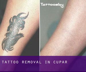 Tattoo Removal in Cupar