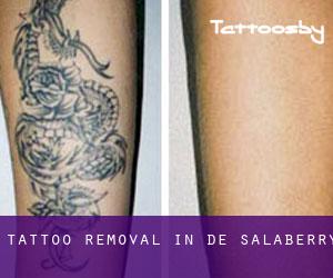 Tattoo Removal in De Salaberry