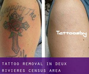 Tattoo Removal in Deux-Rivières (census area)
