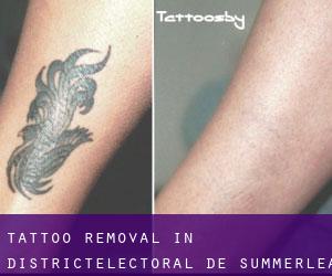 Tattoo Removal in Districtélectoral de Summerlea