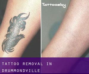 Tattoo Removal in Drummondville