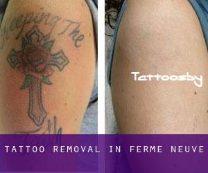 Tattoo Removal in Ferme-Neuve