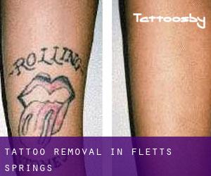 Tattoo Removal in Flett's Springs