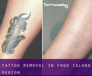 Tattoo Removal in Fogo Island Region