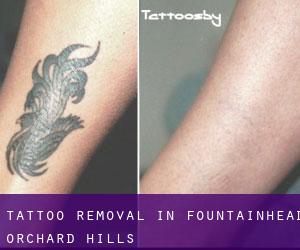 Tattoo Removal in Fountainhead-Orchard Hills