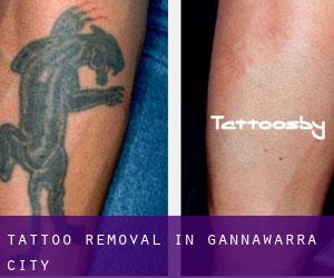 Tattoo Removal in Gannawarra (City)