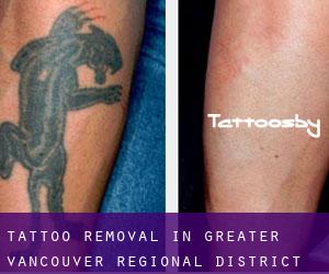 Tattoo Removal in Greater Vancouver Regional District