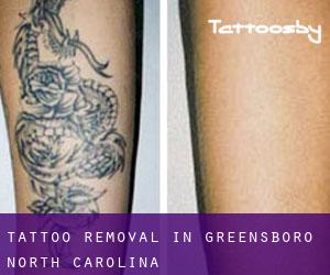 Tattoo Removal in Greensboro (North Carolina)
