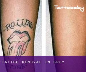 Tattoo Removal in Grey