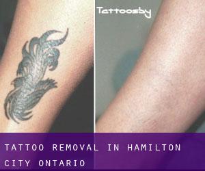Tattoo Removal in Hamilton (City) (Ontario)