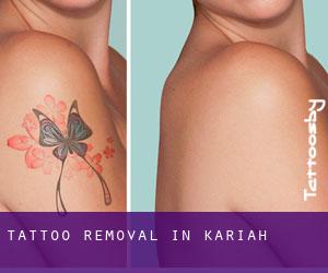 Tattoo Removal in Kariah