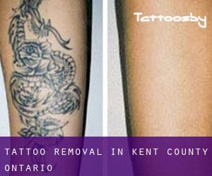 Tattoo Removal in Kent County (Ontario)