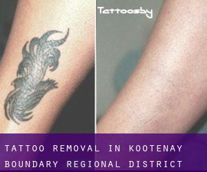 Tattoo Removal in Kootenay-Boundary Regional District
